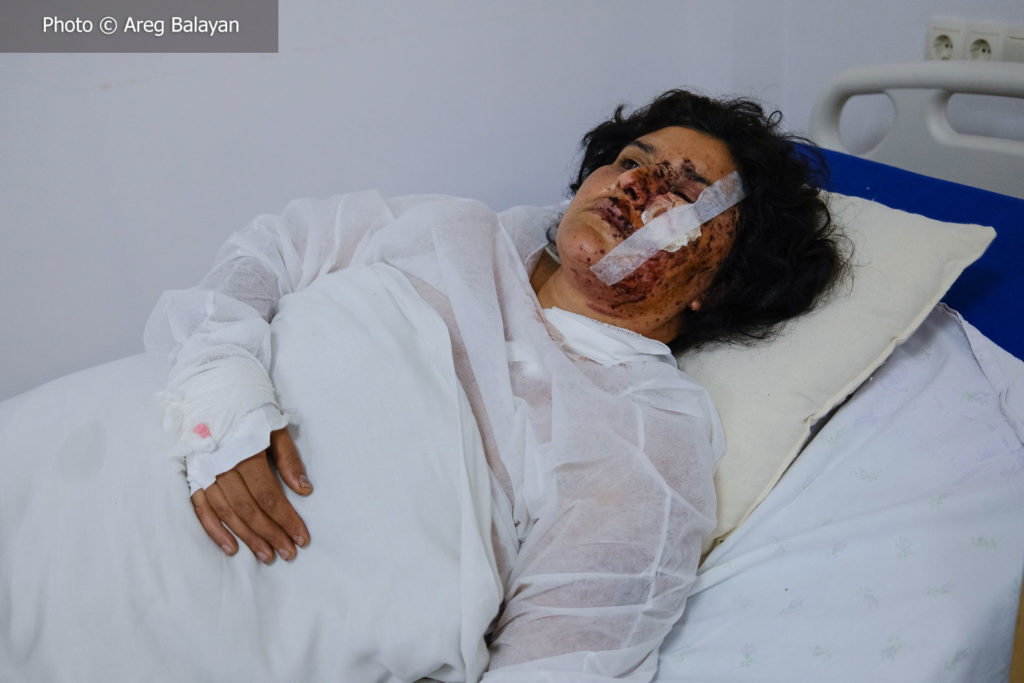 Peaceful Armenian woman with burned face victim of azeri bombing - Photo © Areg Balayan